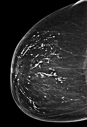 Images of segmental breast calcifications speaking Excellent answer, images of segmental breast calcifications are not